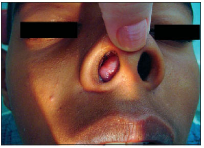 nasal polyps cancer