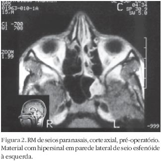 papiloma nasal tomografia)