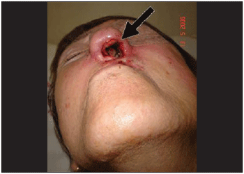 maggots in nose