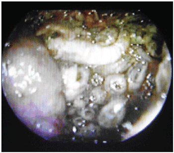 Nasal Myiasis: Case Report and Literature Review
