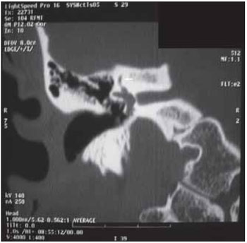 X-Linked Stapes Gusher: CT Findings in One Patient